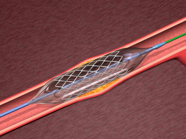 Ученые выяснили, почему полимерные стенты для коронарных артерий потерпели фиаско