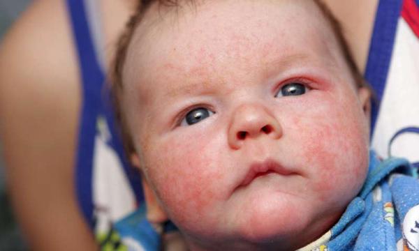 Ученые выявили клетки, тормозящие аллергические реакции при детской экземе