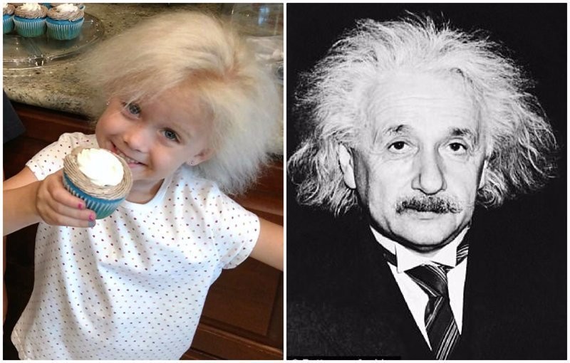 Синдром непослушных волос: редкая генетическая болезнь сделала из ребенка «Эйнштейна»