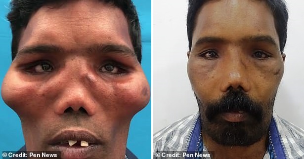 Врачам удалось восстановить лицо мужчины с редкой деформацией черепа