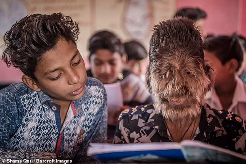 В Индии живет 13-летний мальчик-обротень